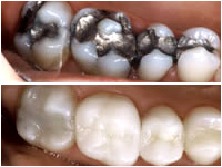 Corson Dentistry Denver inlays-onlays sedation