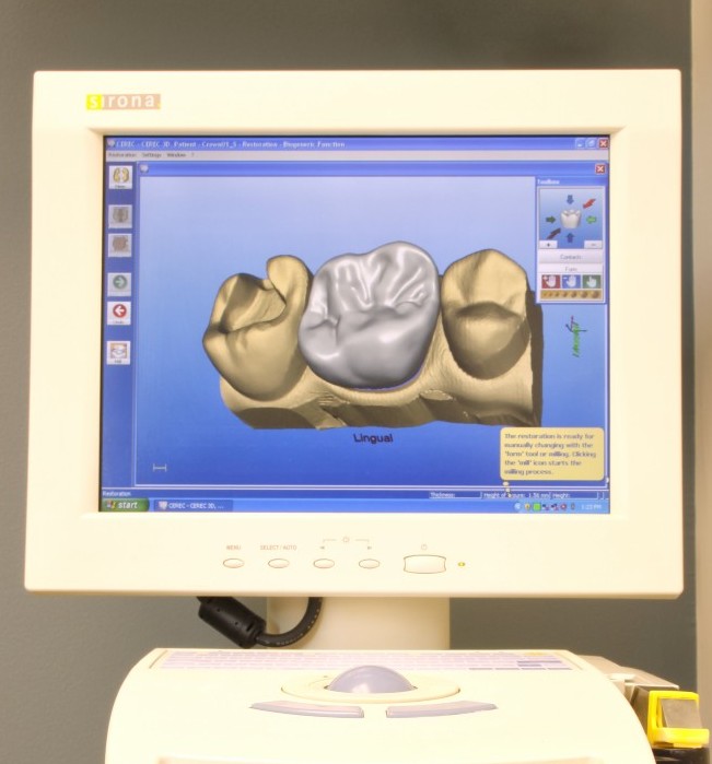 Corson Dentistry Denver Same Day Implants